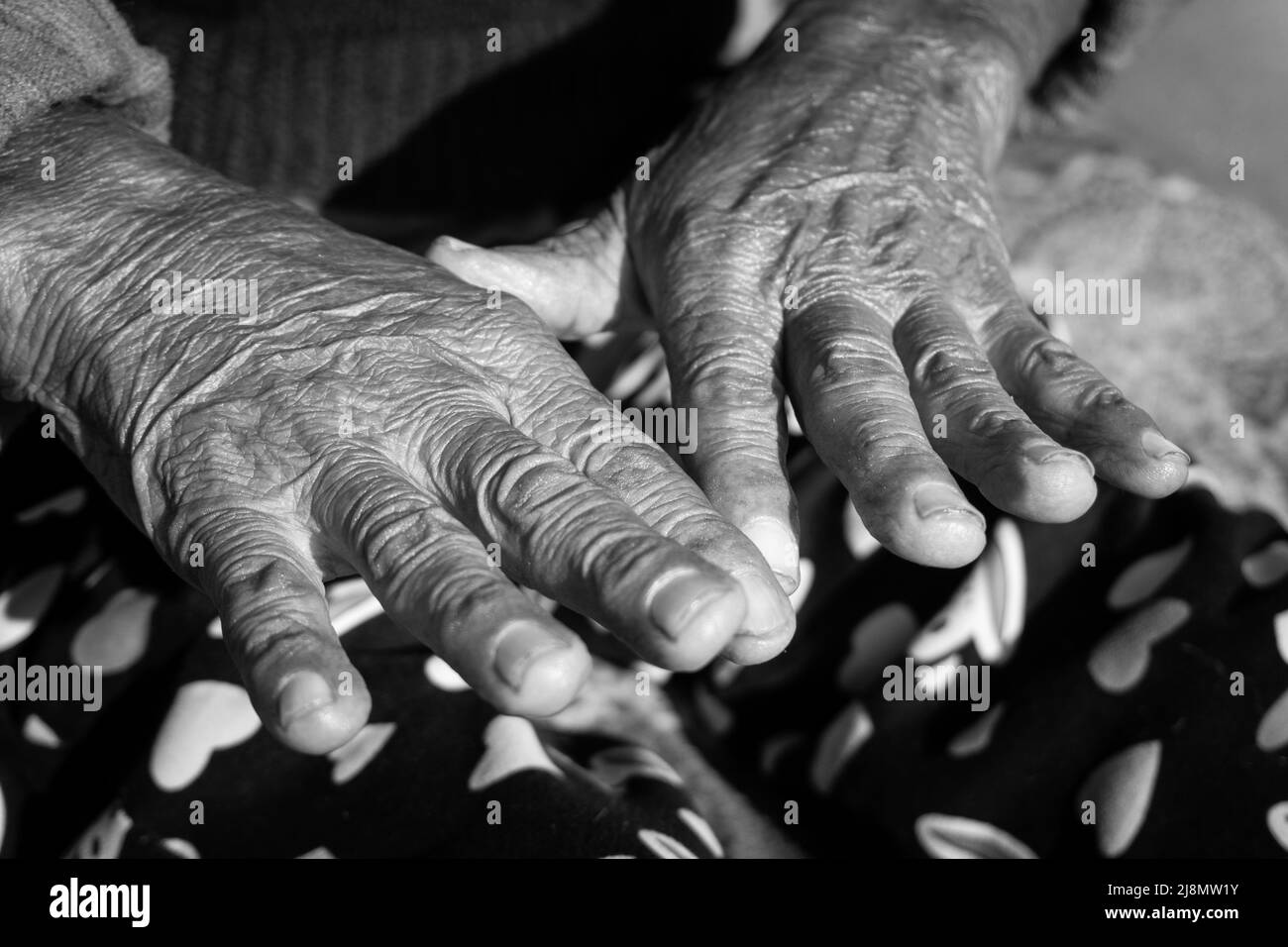 Skin folds arm Black and White Stock Photos & Images - Alamy