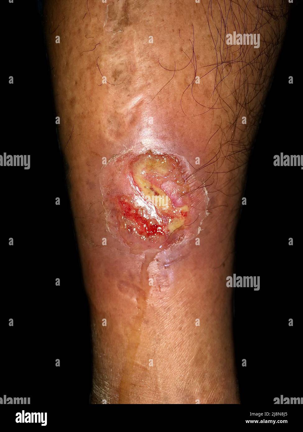 Bacterial wound infection. Infected traumatic wound in the leg of Asian man. Stock Photo