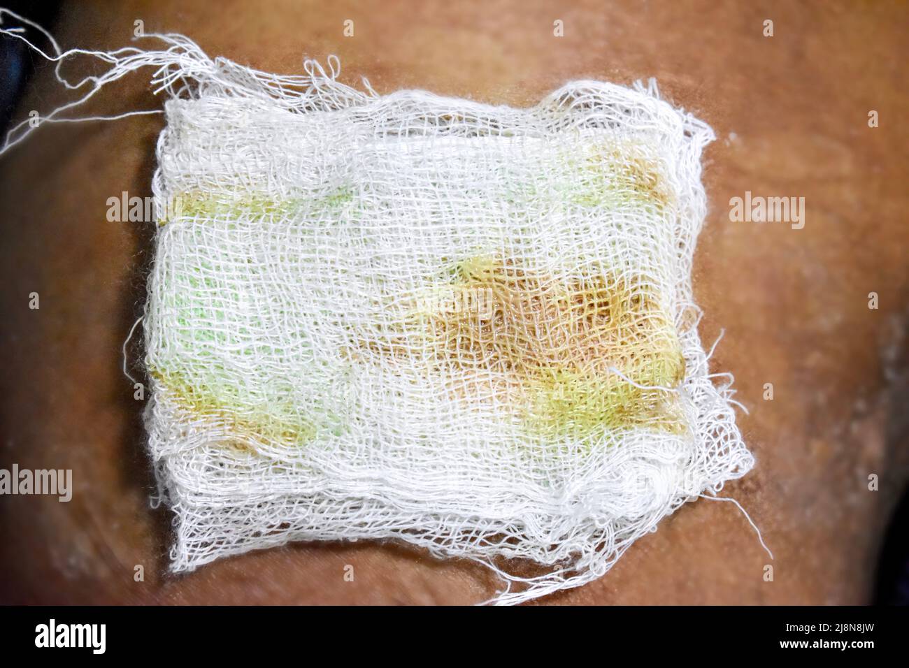 Wet cotton gauze swab with green and brown staining showing Clostridium
