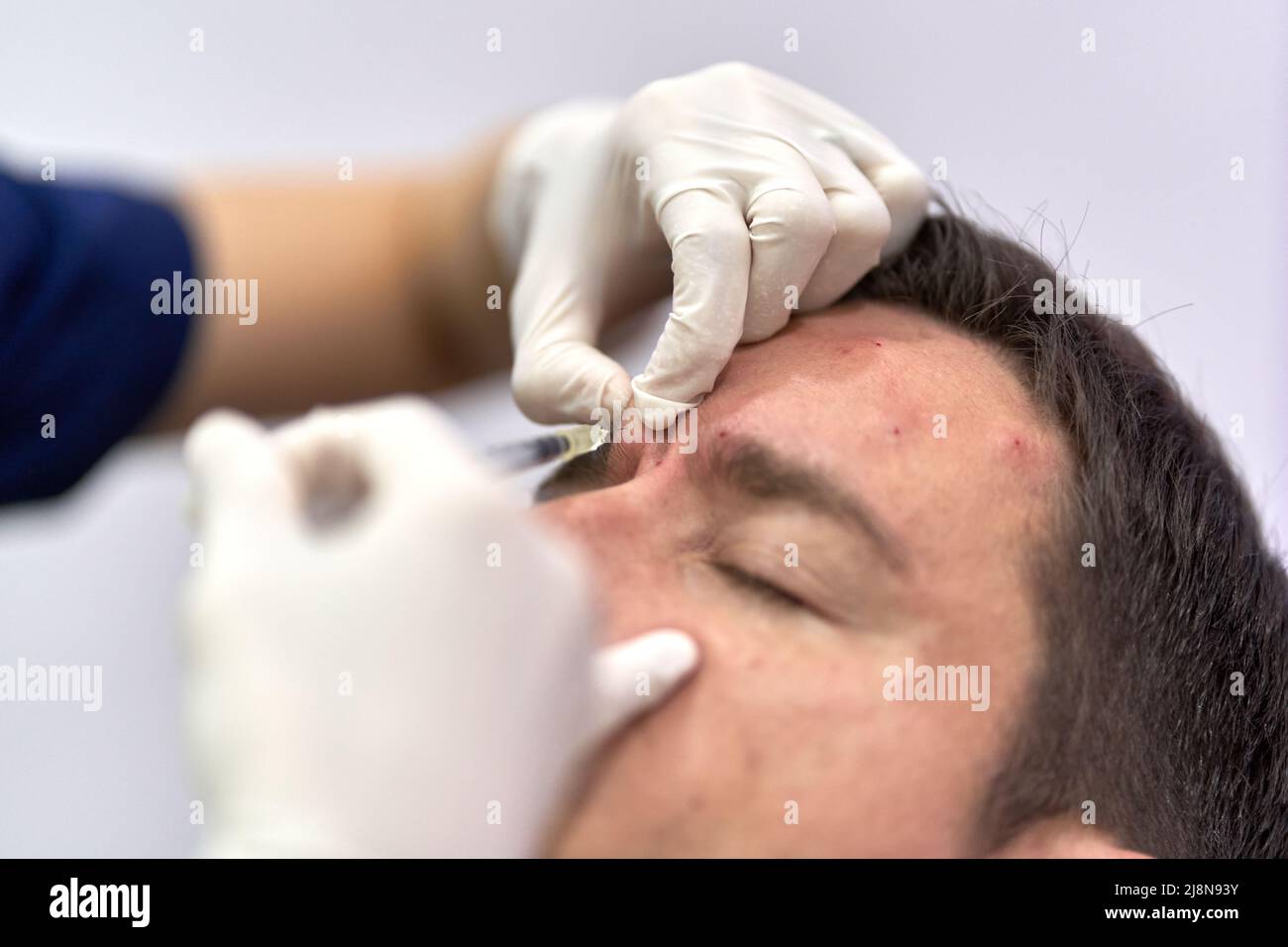 Doctor pinching a piece of skin where he injects botox to a patient Stock Photo