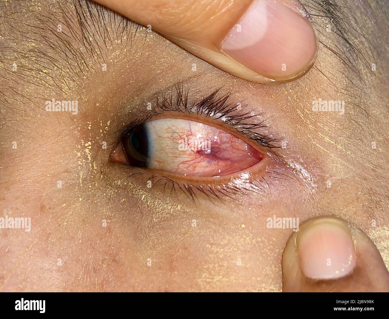 Ocular larva migrans or dilated vessels in left eye of Southeast Asian man. Stock Photo