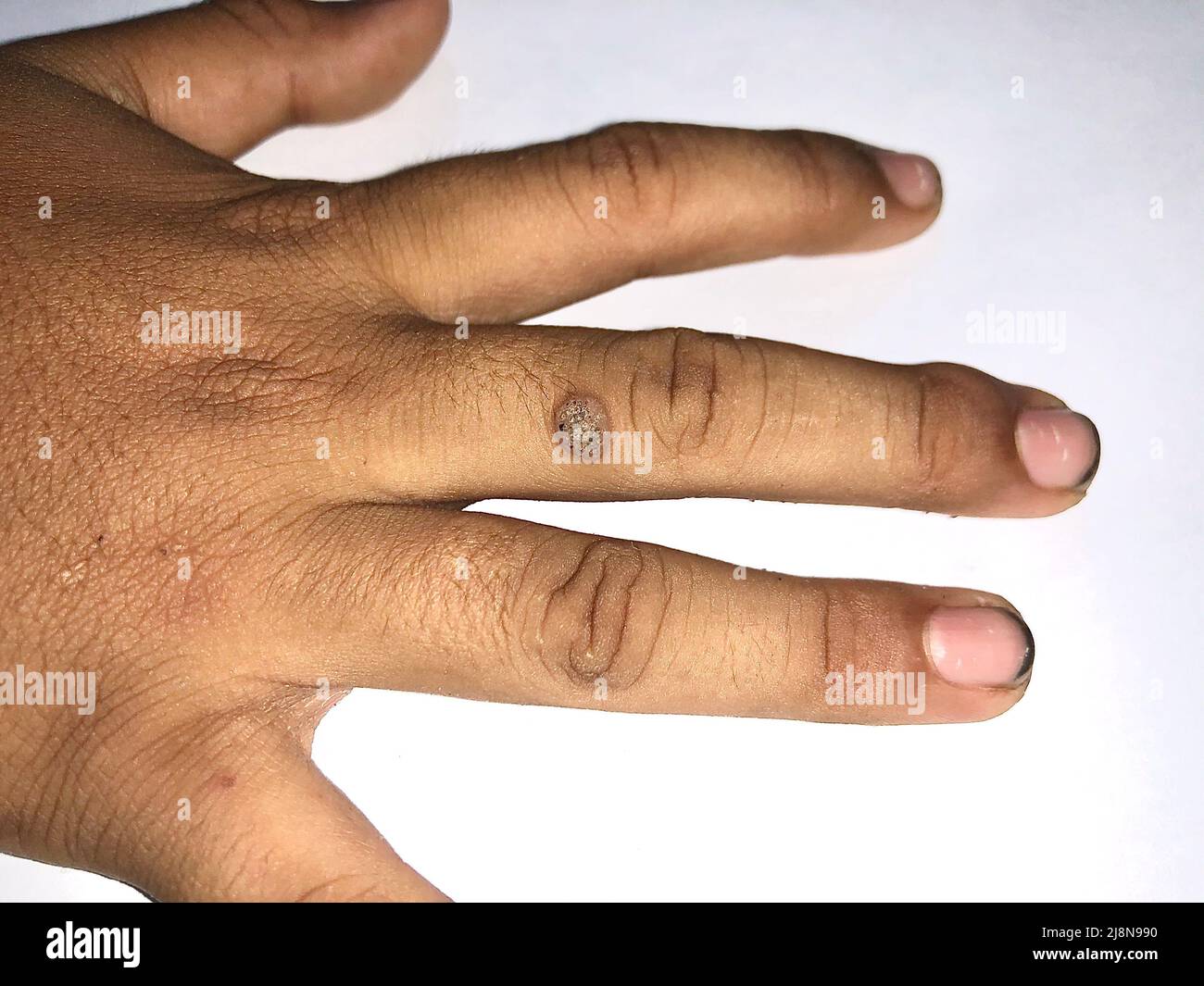 Common wart at dorsal surface of middle finger in Southeast Asian, Myanmar child. It is small growth with a rough texture that looks like a solid blis Stock Photo