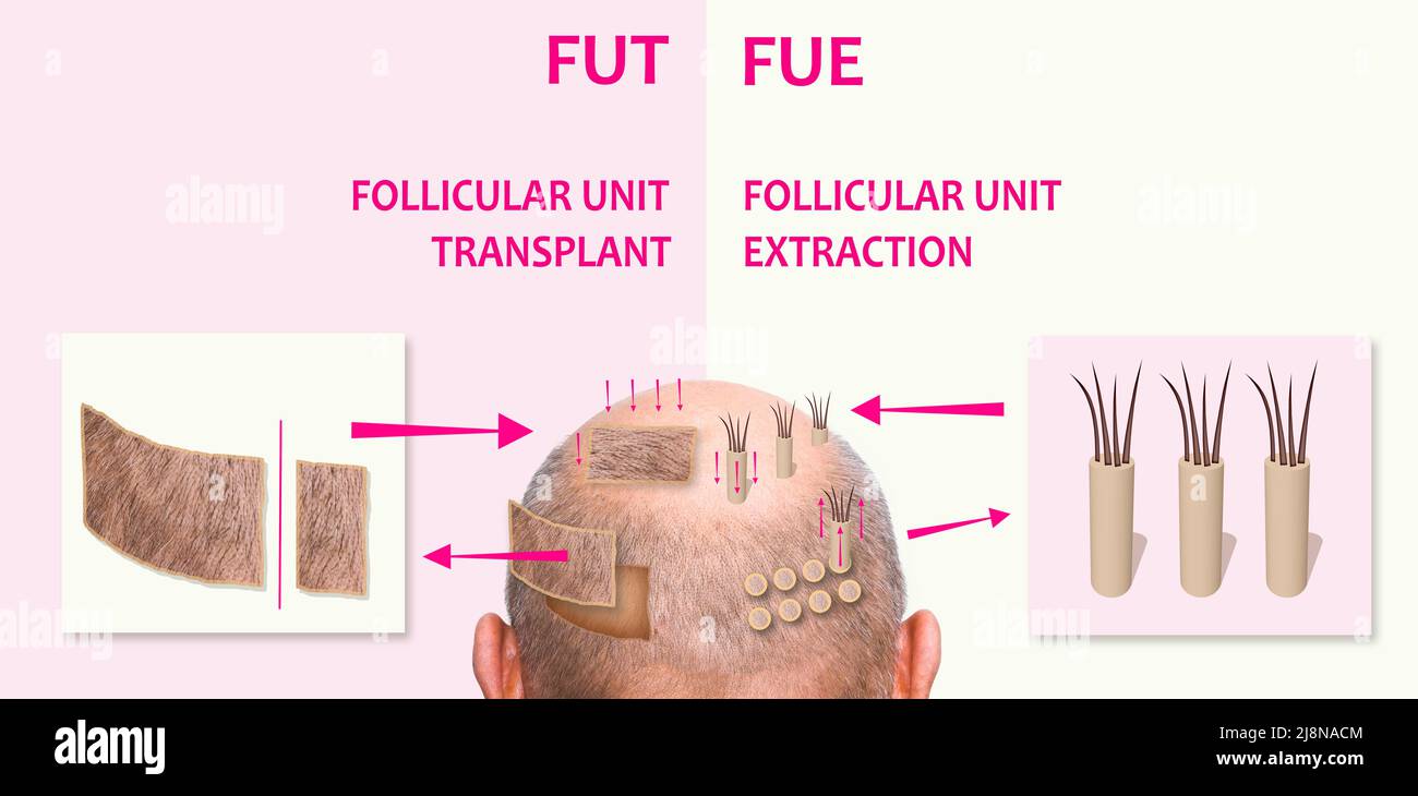 Methods of hair transplantation FUT and FUE fue with transplant as infographic element of illustration. Human alopecia or hair loss problem on adult senior or mature man. Before and after concept Stock Photo