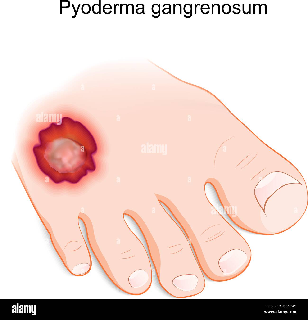 Pyoderma gangrenosum. inflammatory skin disease. Human's foot with a painful ulcer. vector illustration Stock Vector
