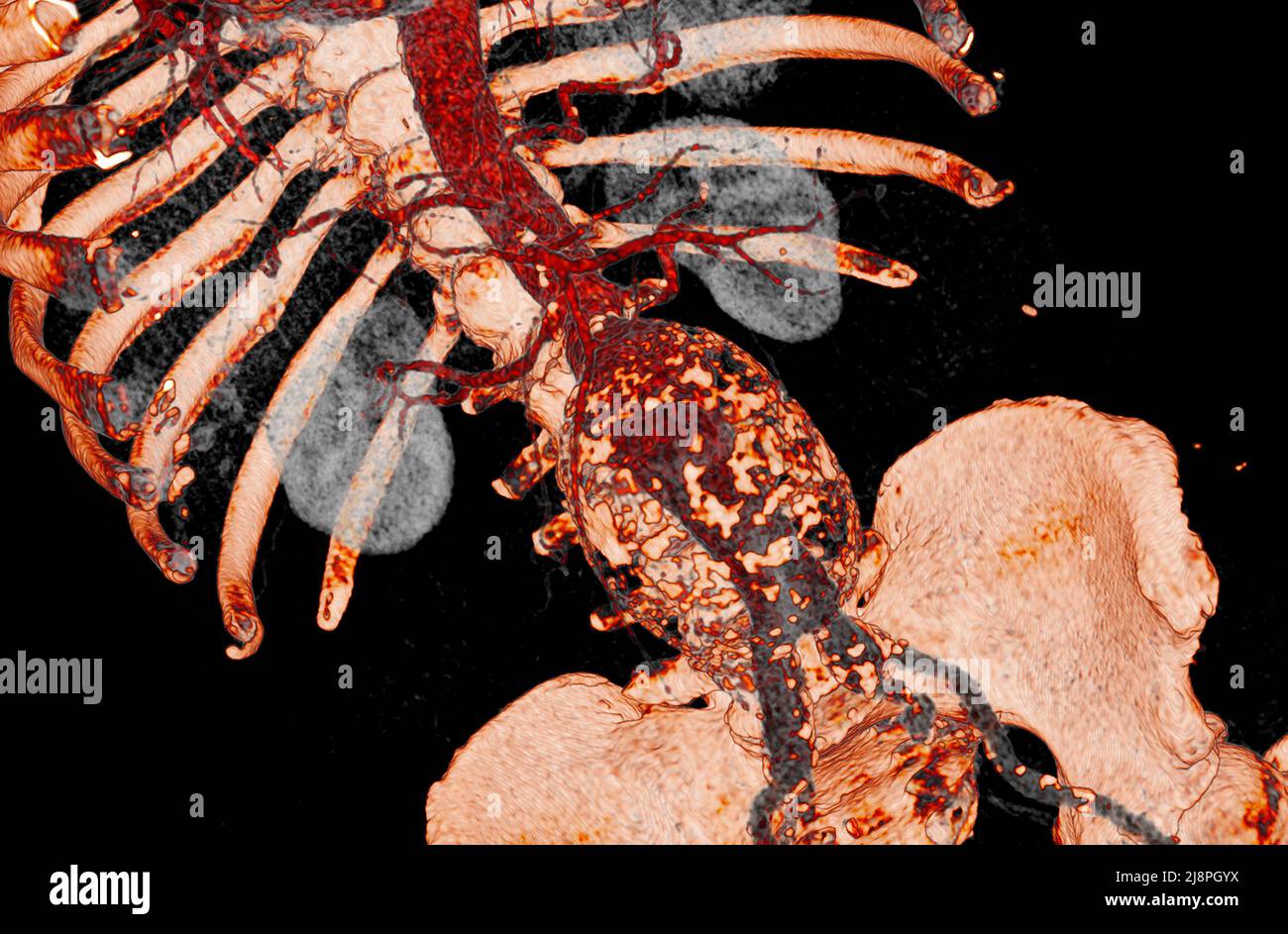 Aortic aneurysm, 3D CT scan Stock Photo - Alamy