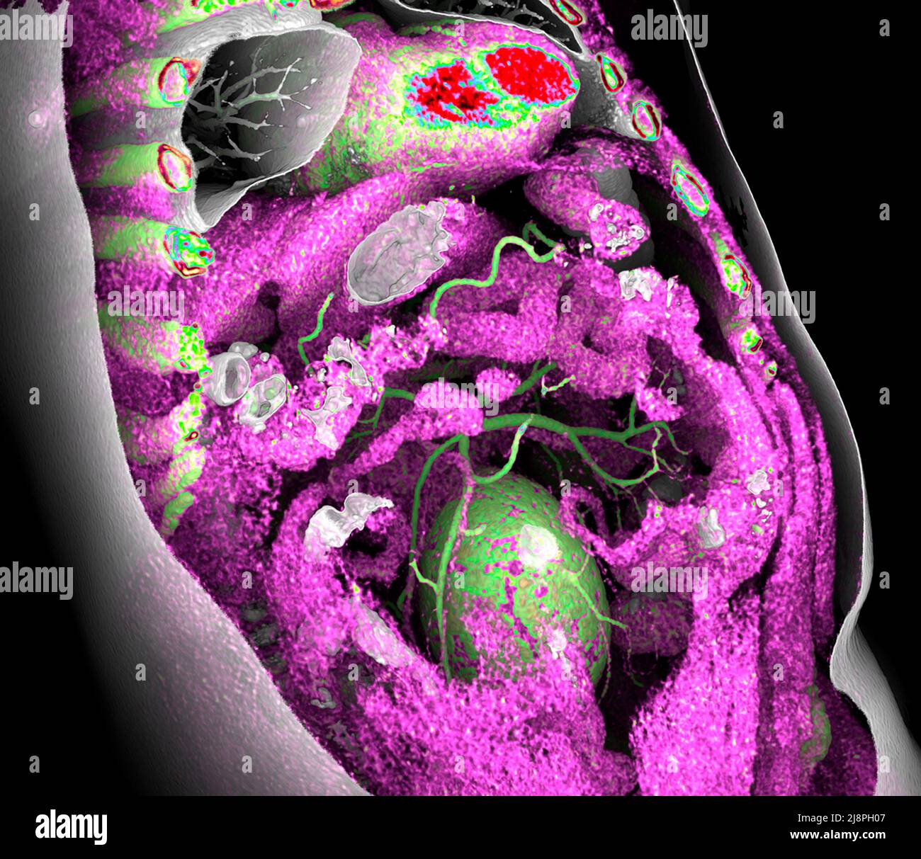 Aortic aneurysm, 3D CT scan Stock Photo - Alamy