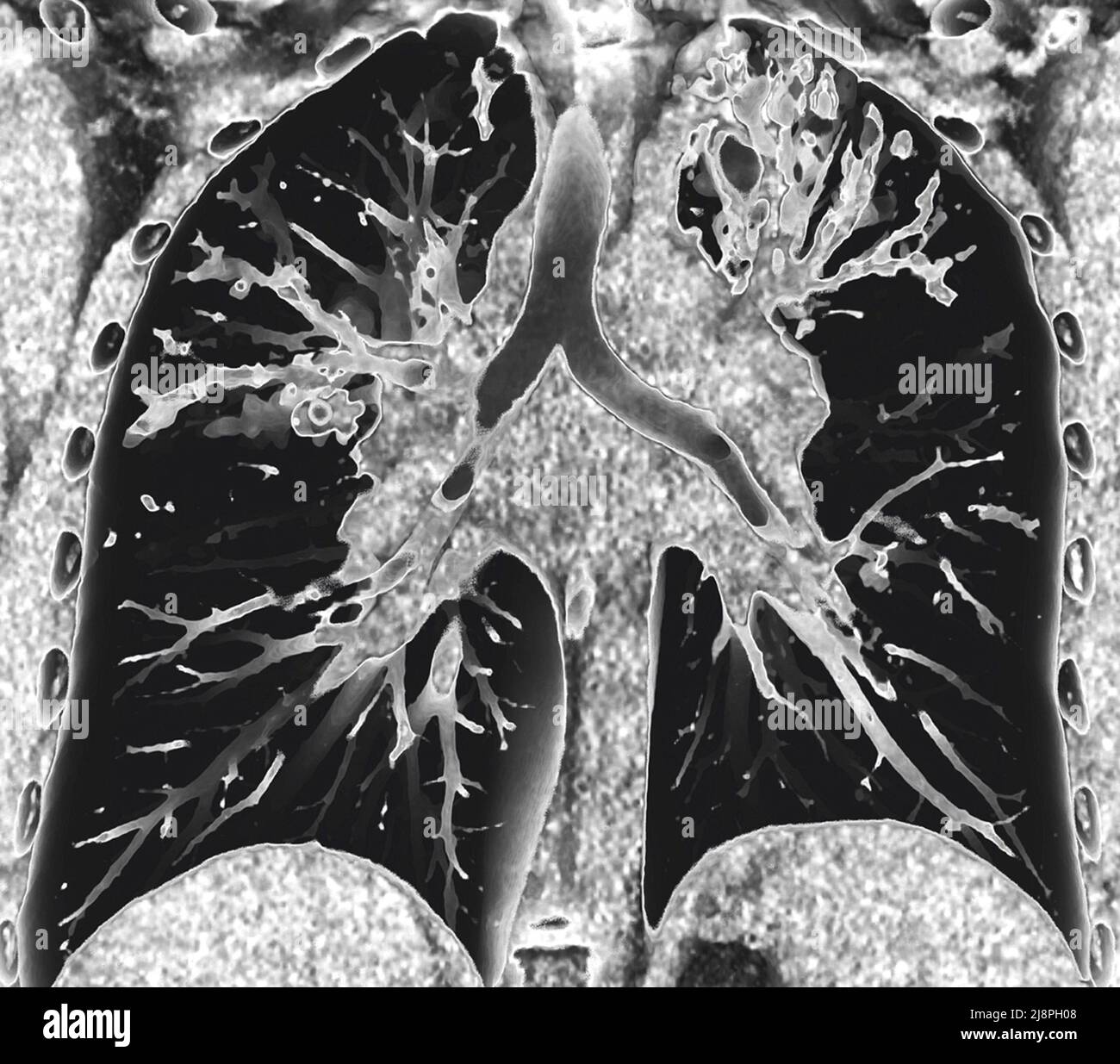 Bronchiectasis, 3D CT scan Stock Photo Alamy