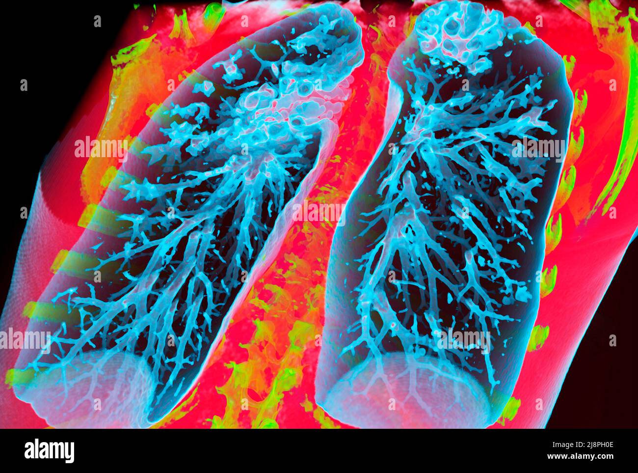 Bronchiectasis, 3D CT scan Stock Photo - Alamy