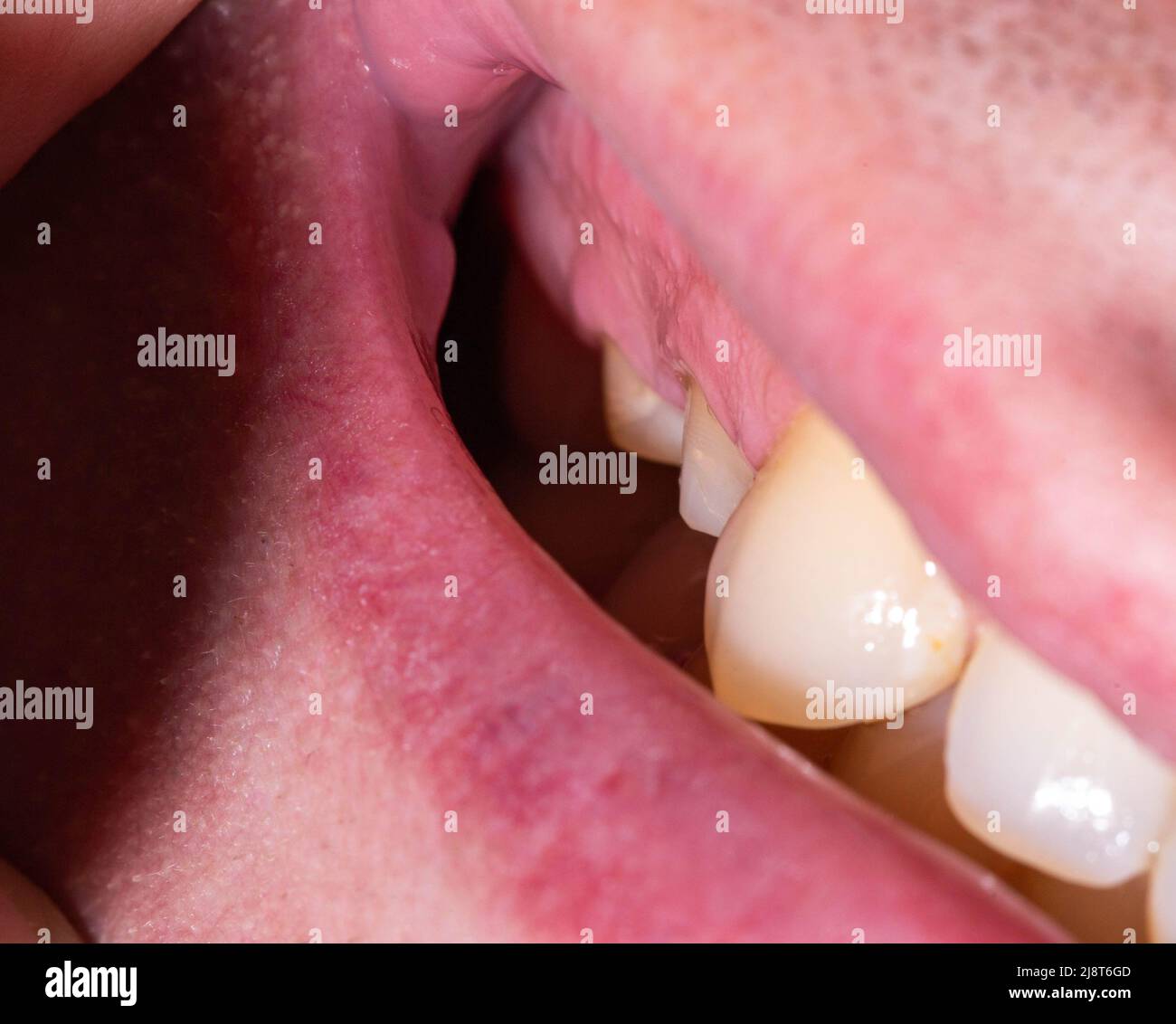 Dissection of decayed teeth for the installation of a dental crown in