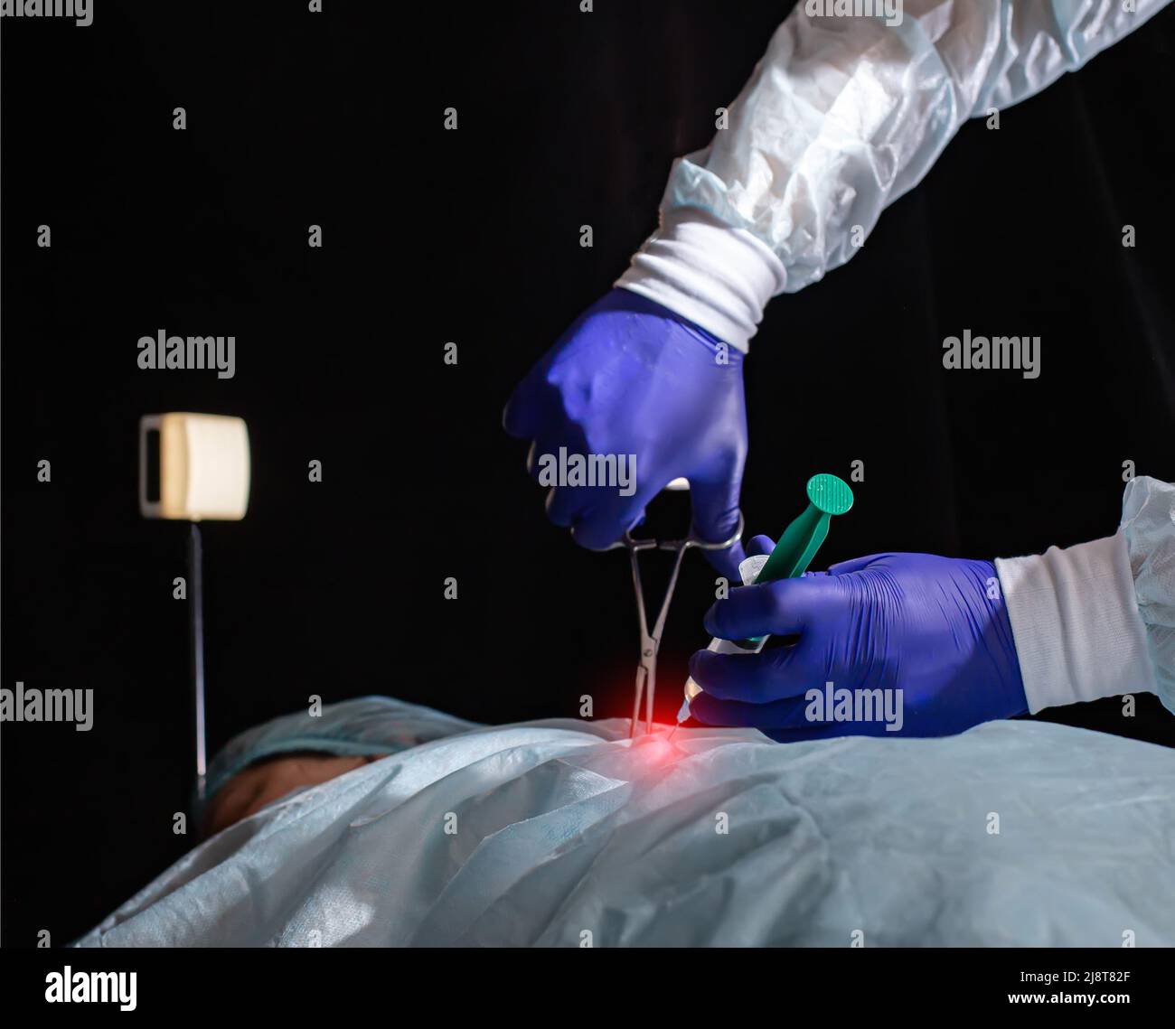 Laparoscopic gallbladder removal surgery hires stock photography and