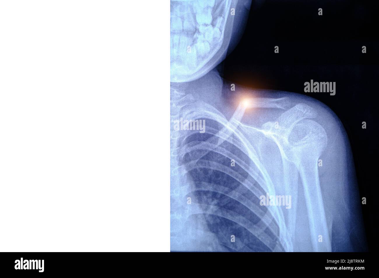 X-ray image broken collarbone person. Stock Photo