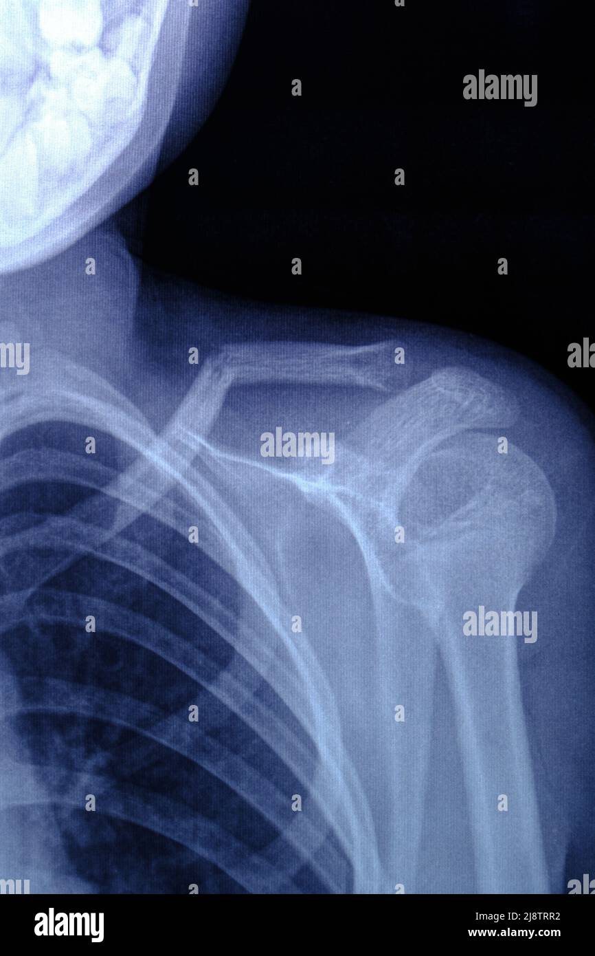 X-ray image broken collarbone person Stock Photo