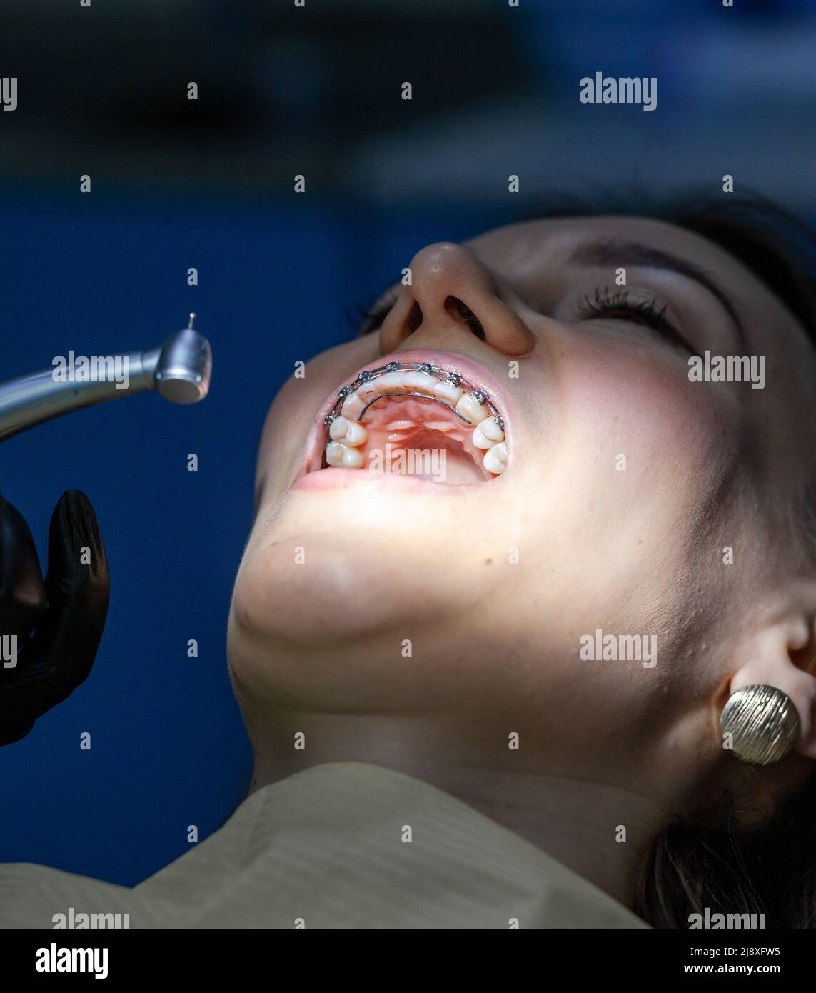 Installing a retainer after wearing braces. The process of removing