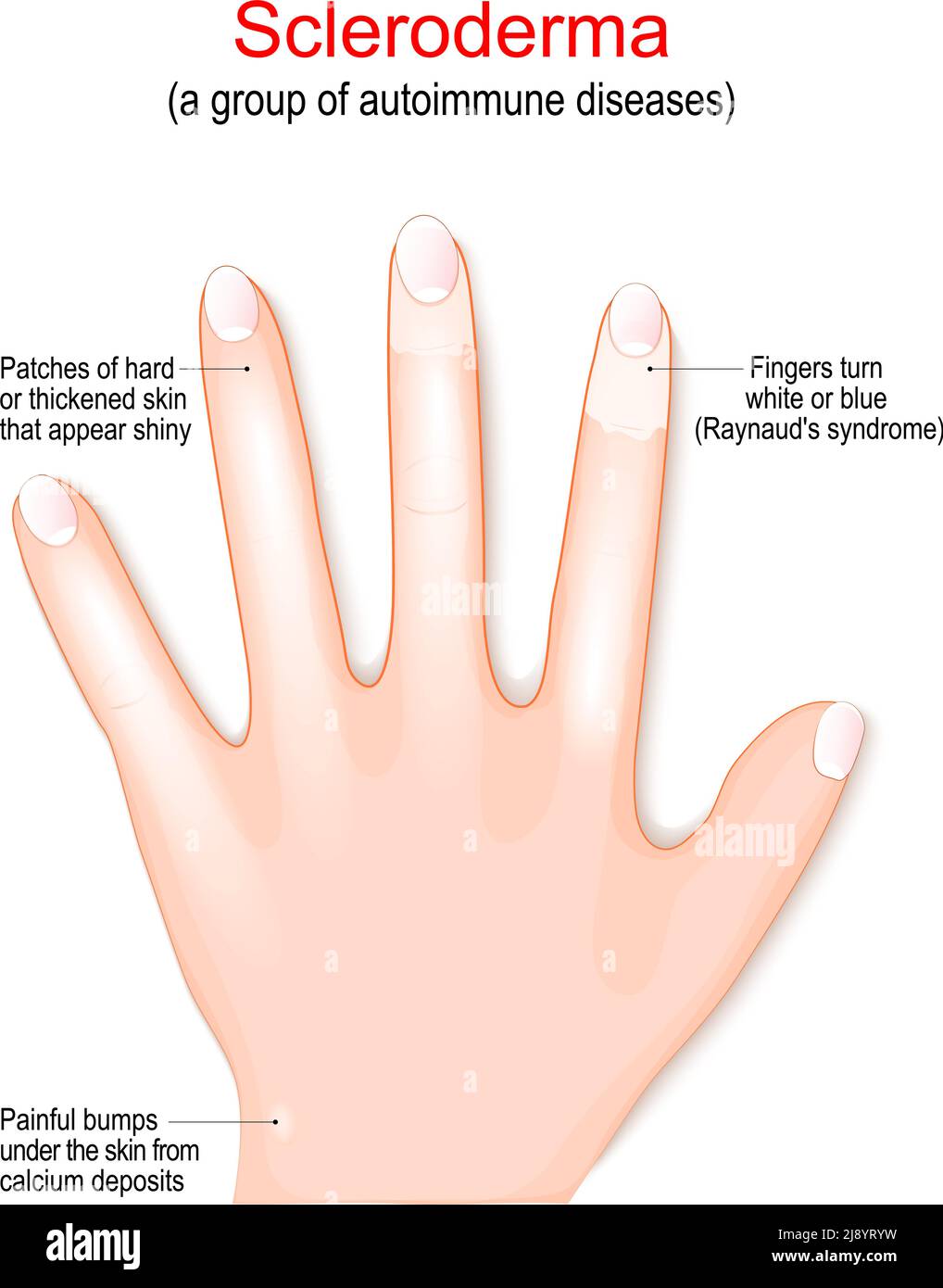 Scleroderma Skin Symptoms