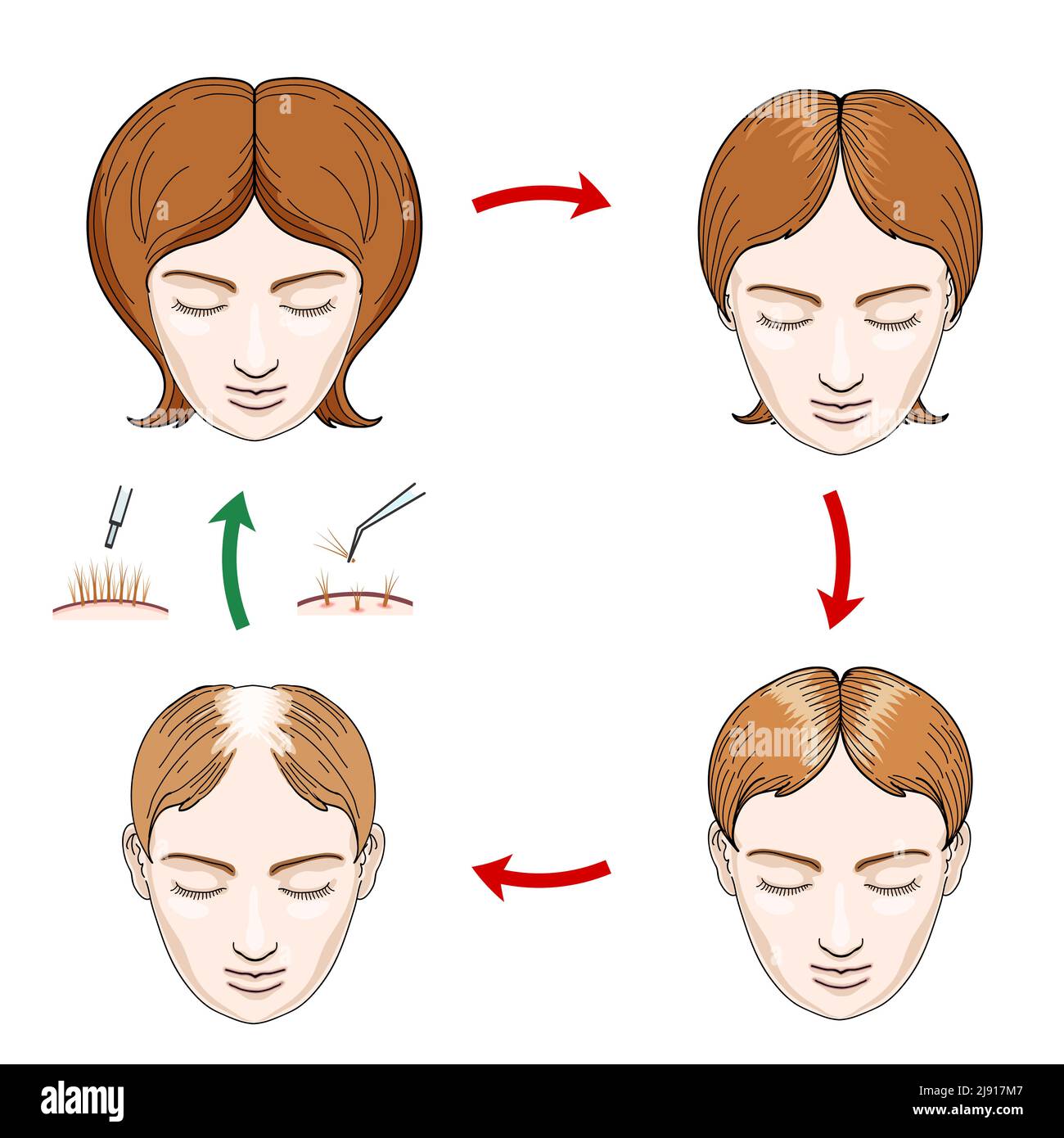 Female hair loss and hair transplantation icons. Hair loss woman, care hair, head female, scalp human, growth hair, vector illustration Stock Vector