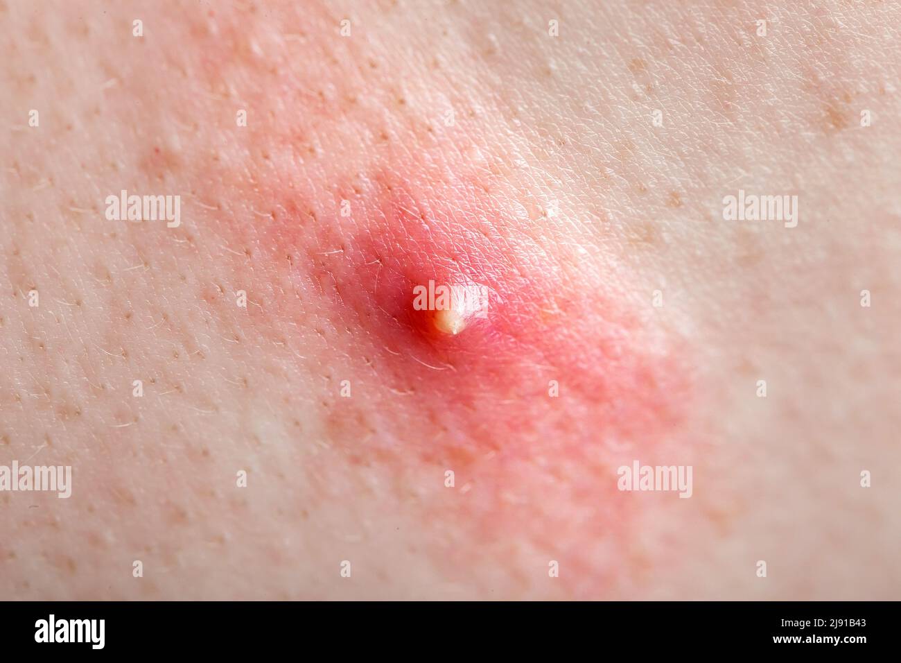 acne on inflamed human skin, teen body health and problems of red pimple  close-up texture of human skin Stock Photo - Alamy