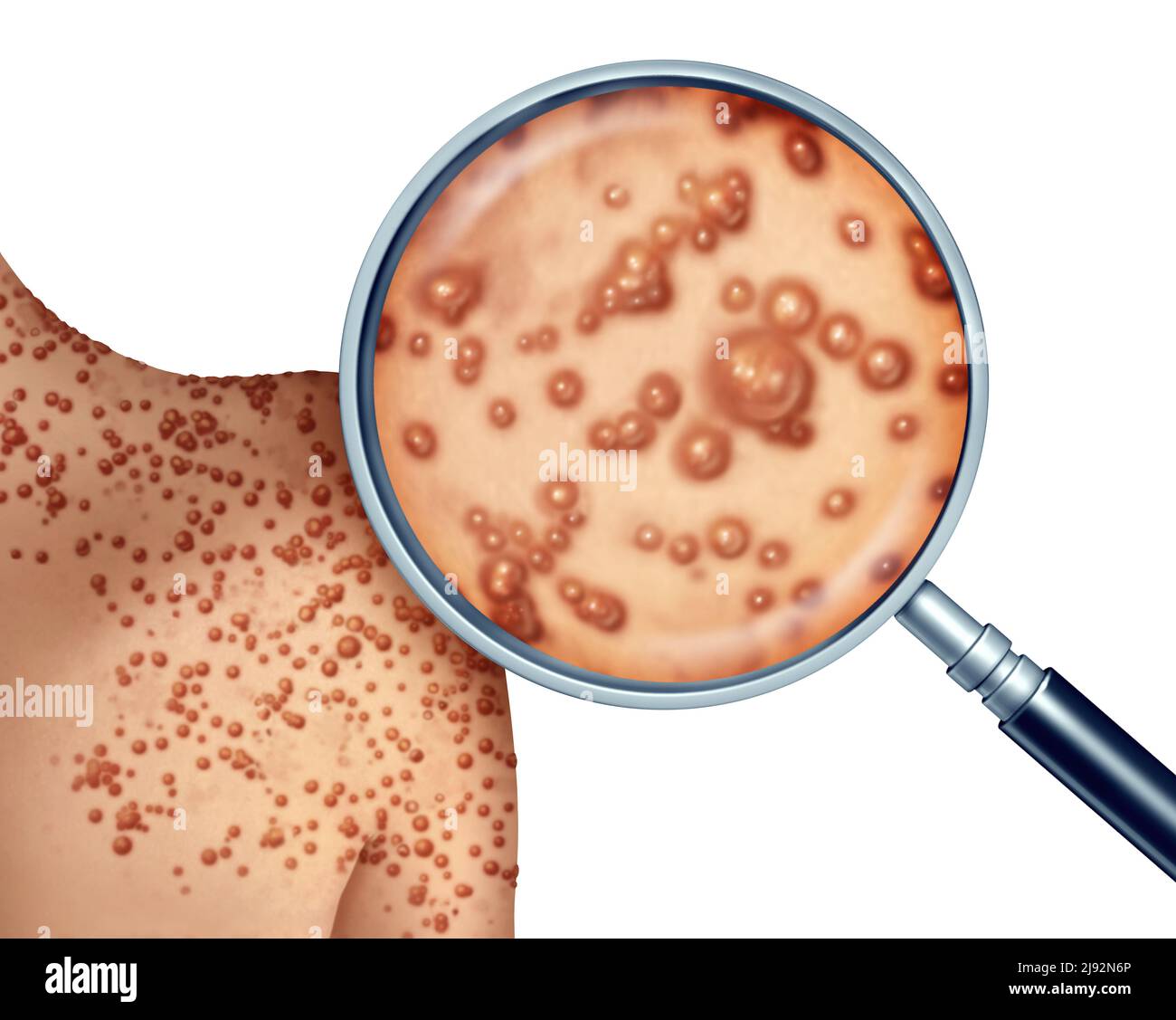Monkeypox Virus Outbreak as a contagious infection as blisters and leisons on the skin representing transmission of an infected person. Stock Photo