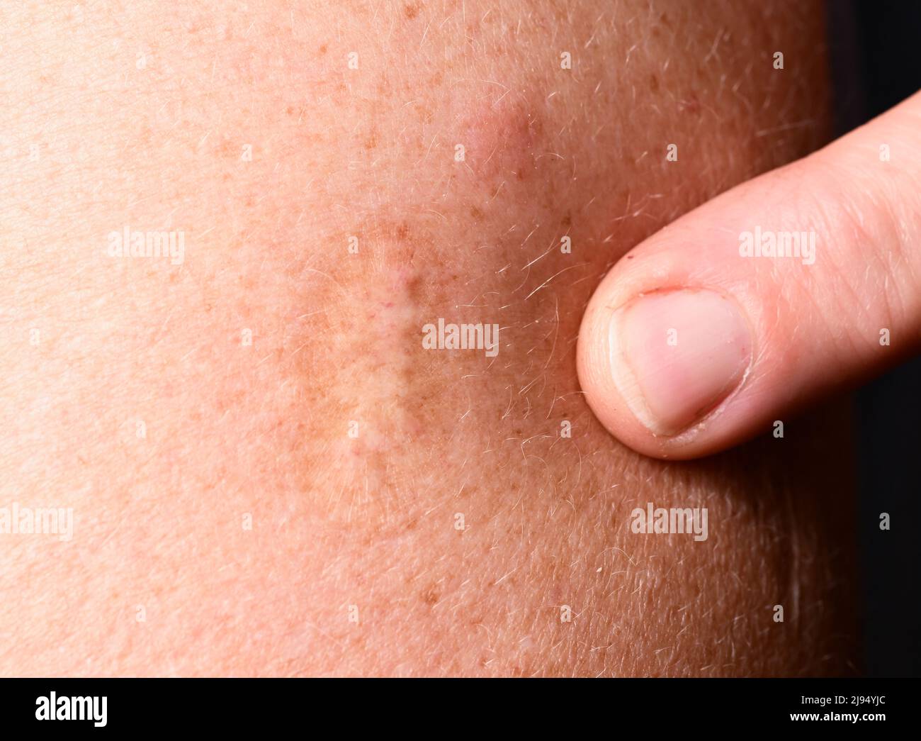 Stuttgart, Germany. 20th May, 2022. A scar from a smallpox vaccination is visible on an upper arm. Smallpox was long considered one of the most dangerous diseases for humans. Vaccines saved the day, and since 1980 the world has been considered free of smallpox. In the meantime, more and more countries are reporting evidence and suspected cases of monkeypox. There is no approved vaccination specifically against monkeypox. According to historical data, however, a smallpox vaccination provides good protection against monkeypox - and probably for life. Credit: Bernd Weißbrod/dpa/Alamy Live News Stock Photo