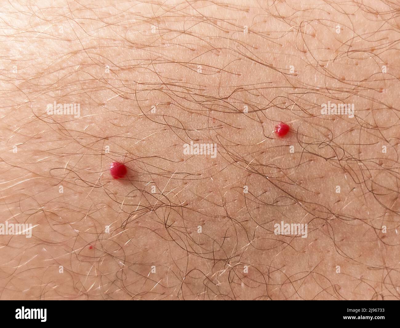 Close up photo of cherry angioma on human hairy skin Stock Photo