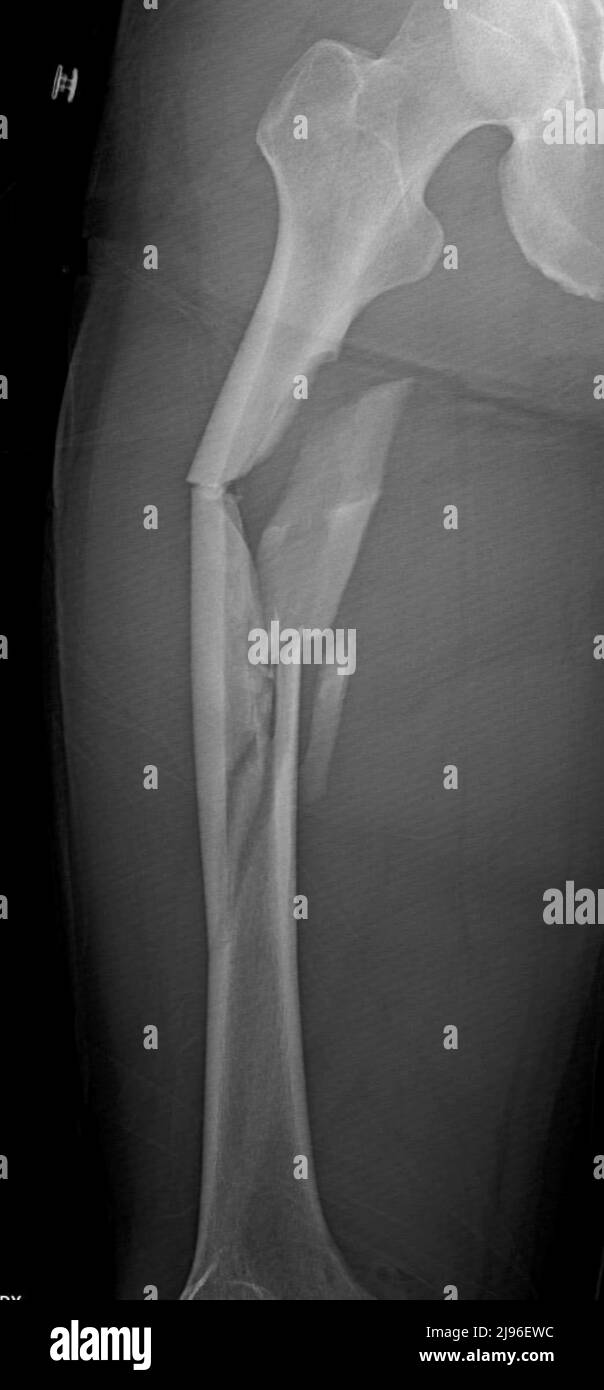 Comminuted femur fracture, X-ray Stock Photo