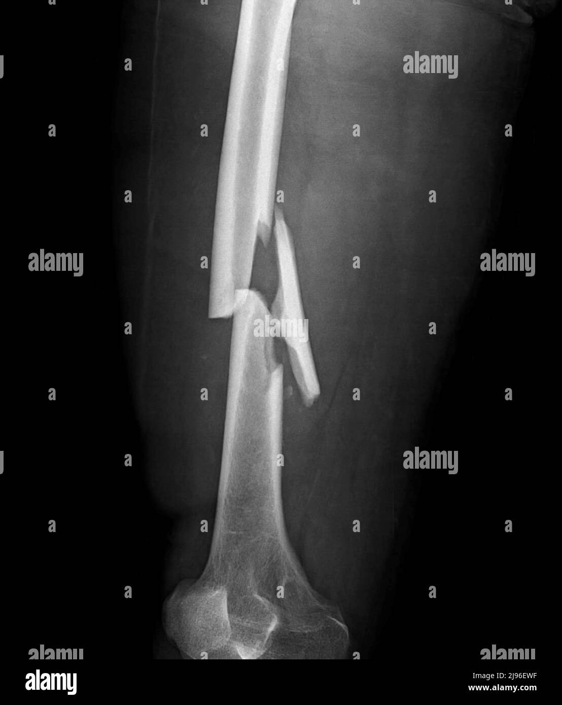 Comminuted femur fracture, X-ray Stock Photo