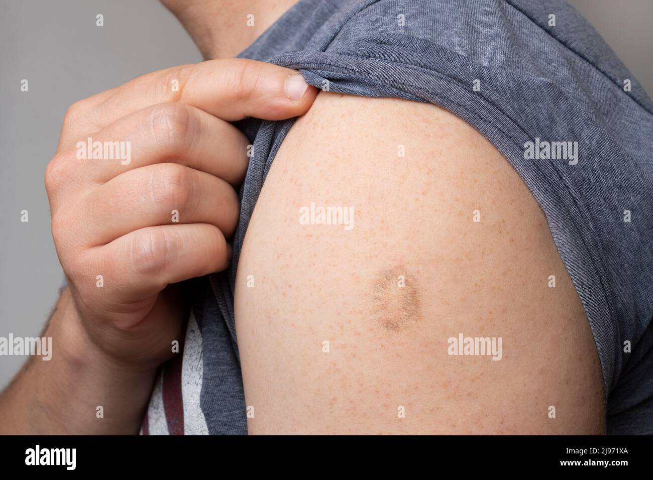 Monkeypox and smallpox vaccine scar on young man's arm Stock Photo