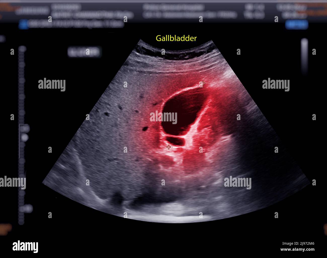 Gallbladder Ultrasound Stones gallbladder-ultrasound-stones