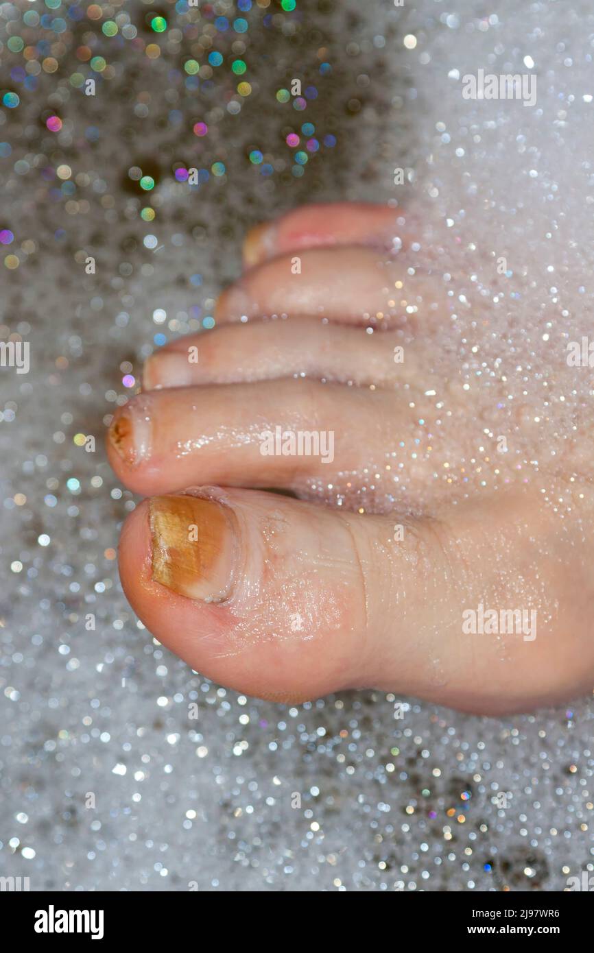 Diabetic foot Stock Photo
