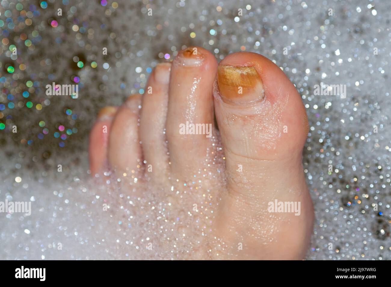 Diabetic foot Stock Photo