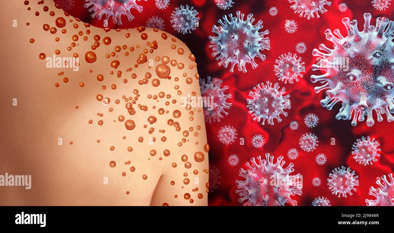 Monkeypox Virus Outbreak as a contagious infection as blisters and leisons on the skin representing transmission of an infected person. Stock Photo