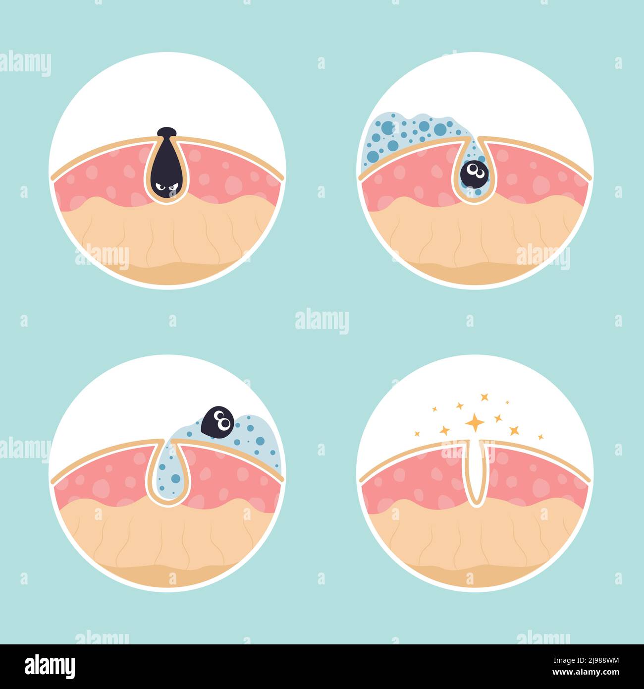 Cleaning clogged pores process flat vector illustration. Steps of blackheads, sebum or pimples removal, skin cleaning foam, skin care. Teenager skin. Shrinking and minimizing face pores concept. Stock Vector
