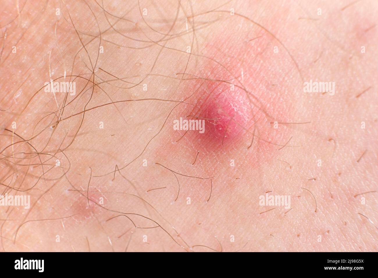 A large red pimple on a skin. Inflammation on the skin, acne Stock Photo - Alamy