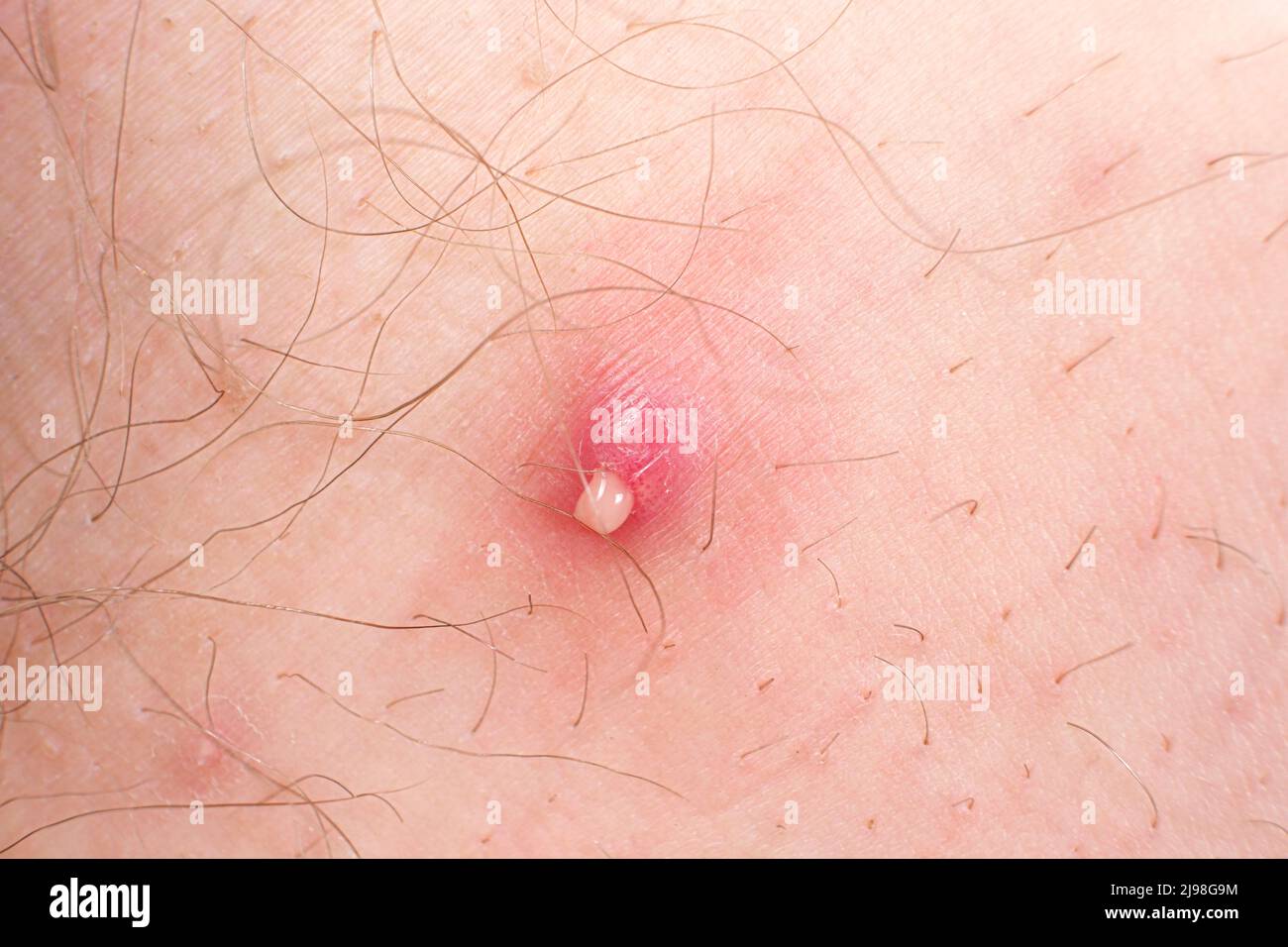 bacon violin Mellemøsten Macro photo of a large red pimple with the release of pus on human skin  Stock Photo - Alamy