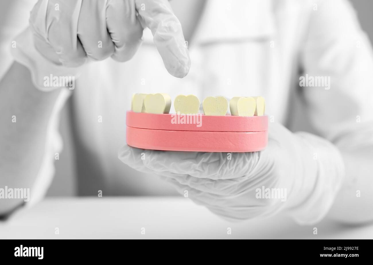 Dentist forefinger pointing to yellow teeth at jaw model. Dental plaque