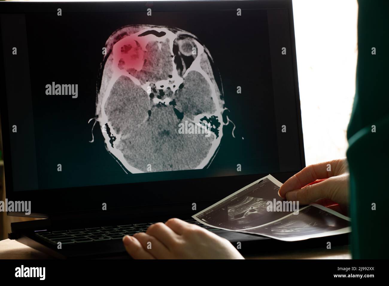 3D computed tomography of the brain with a fracture of the frontal part of the skull after injury on laptop screens on the table on laptop screens at Stock Photo