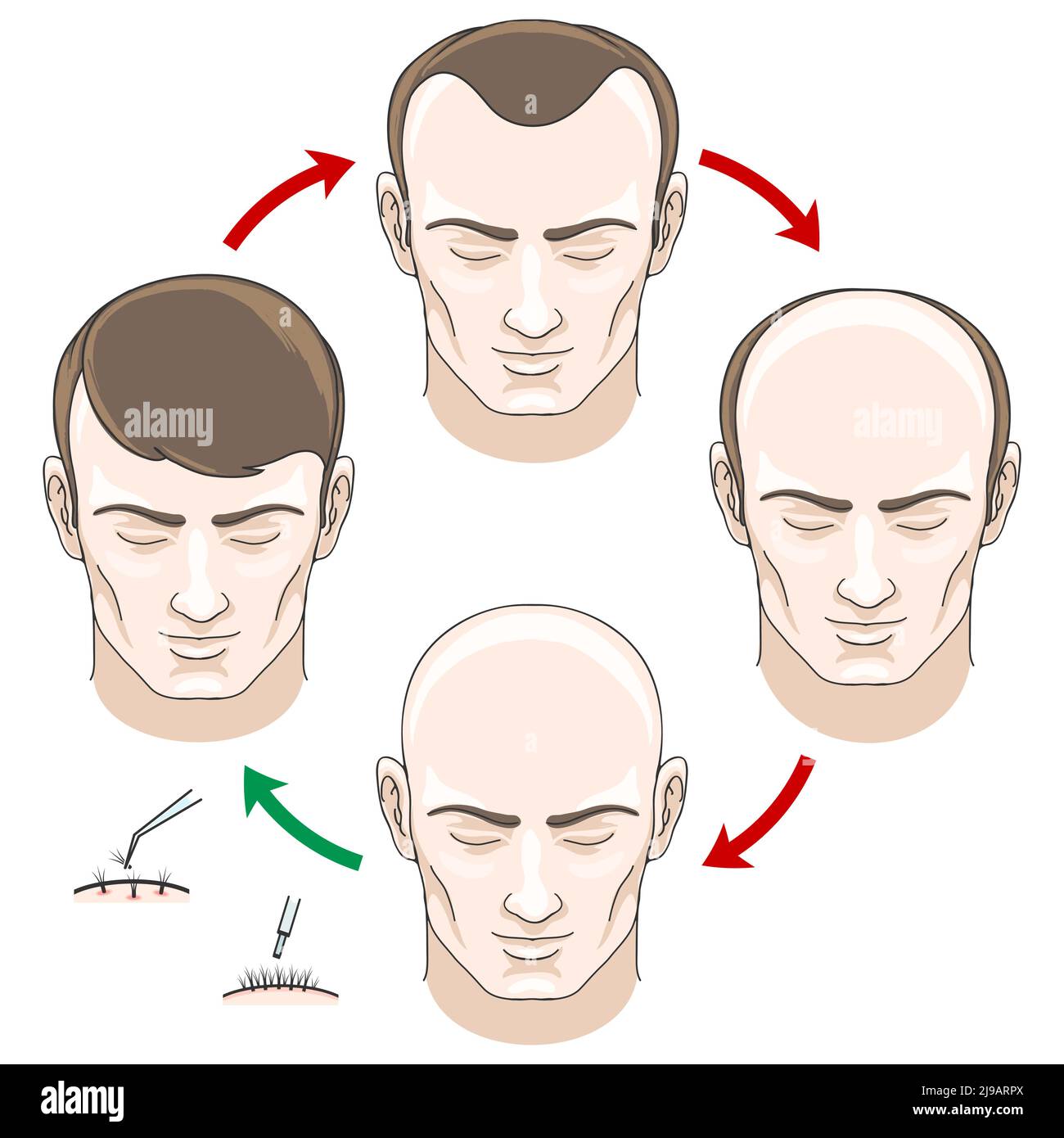 Stages of hair loss, hair treatment and hair transplantation. Hair loss, bald and care, health haor, human hair growth, vector illustration Stock Vector