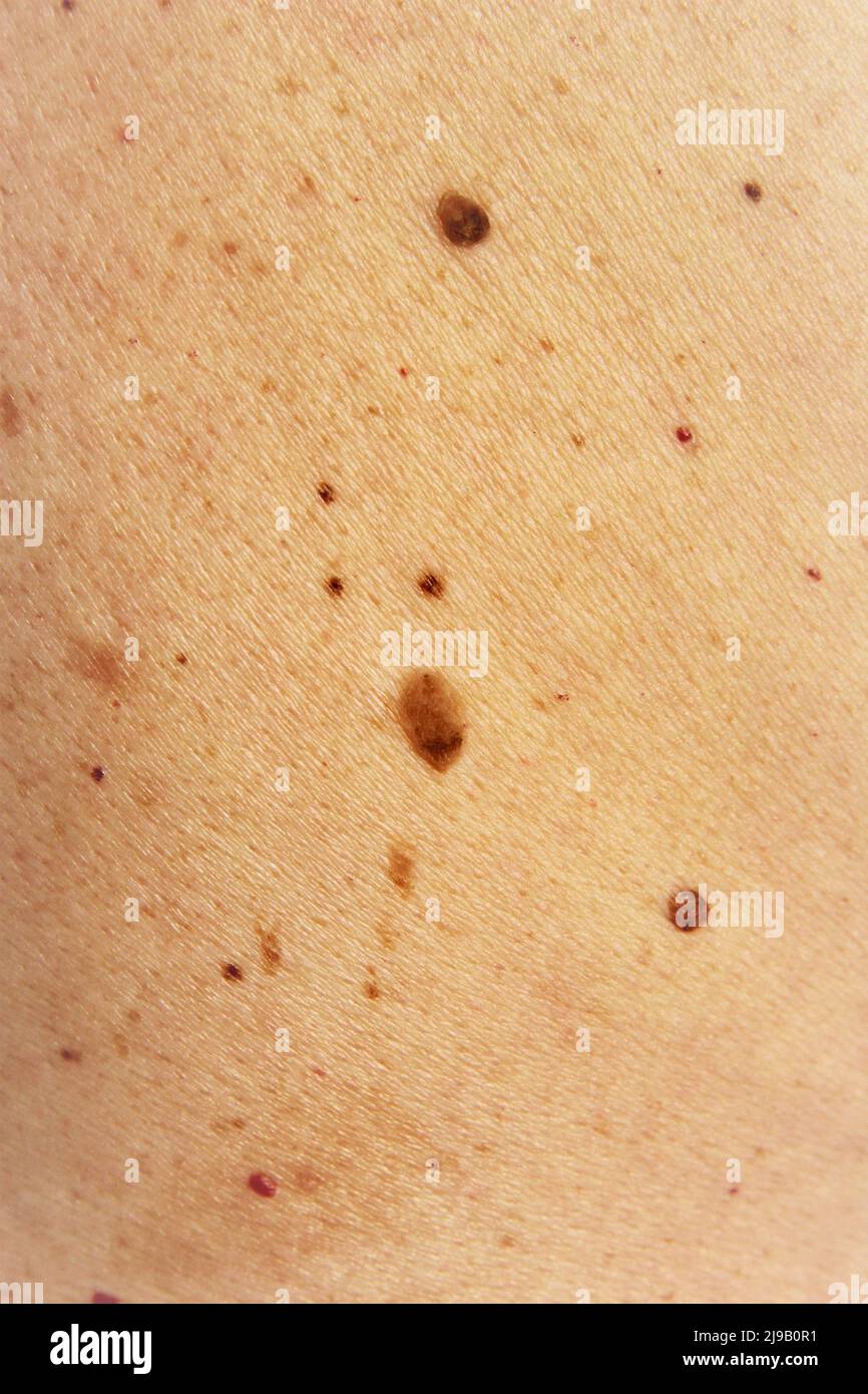 Moles and birthmark on human skin texture. photo vertical full frame ...