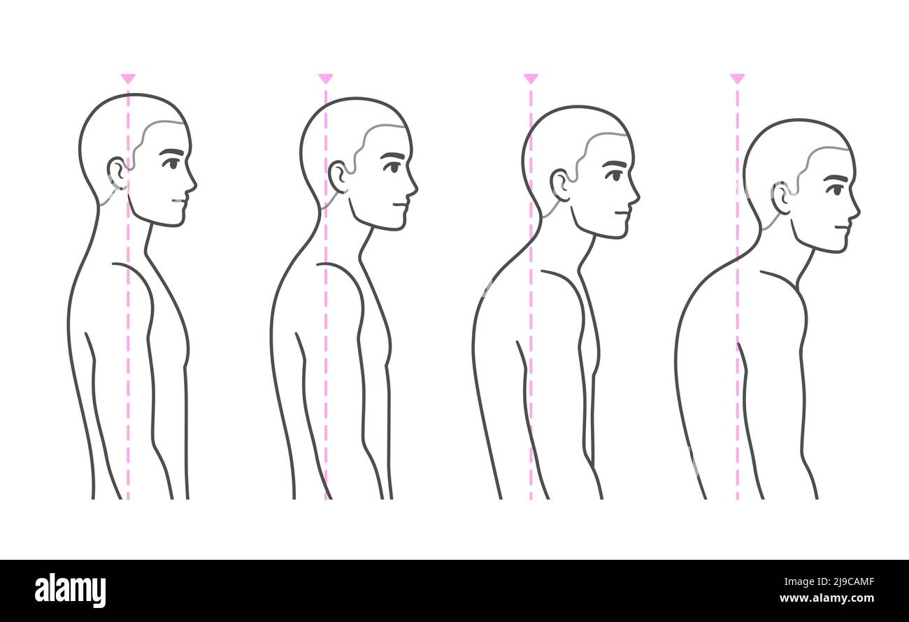 Spine kyphosis progression stages. Young man with rounded back and shoulders, forward head syndrome. Back posture problems medical diagram, vector ill Stock Vector