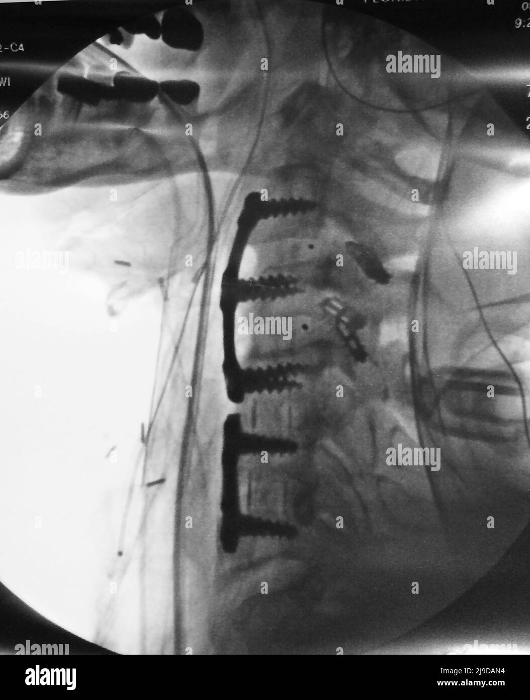 Spinal Fusion Stock Photo