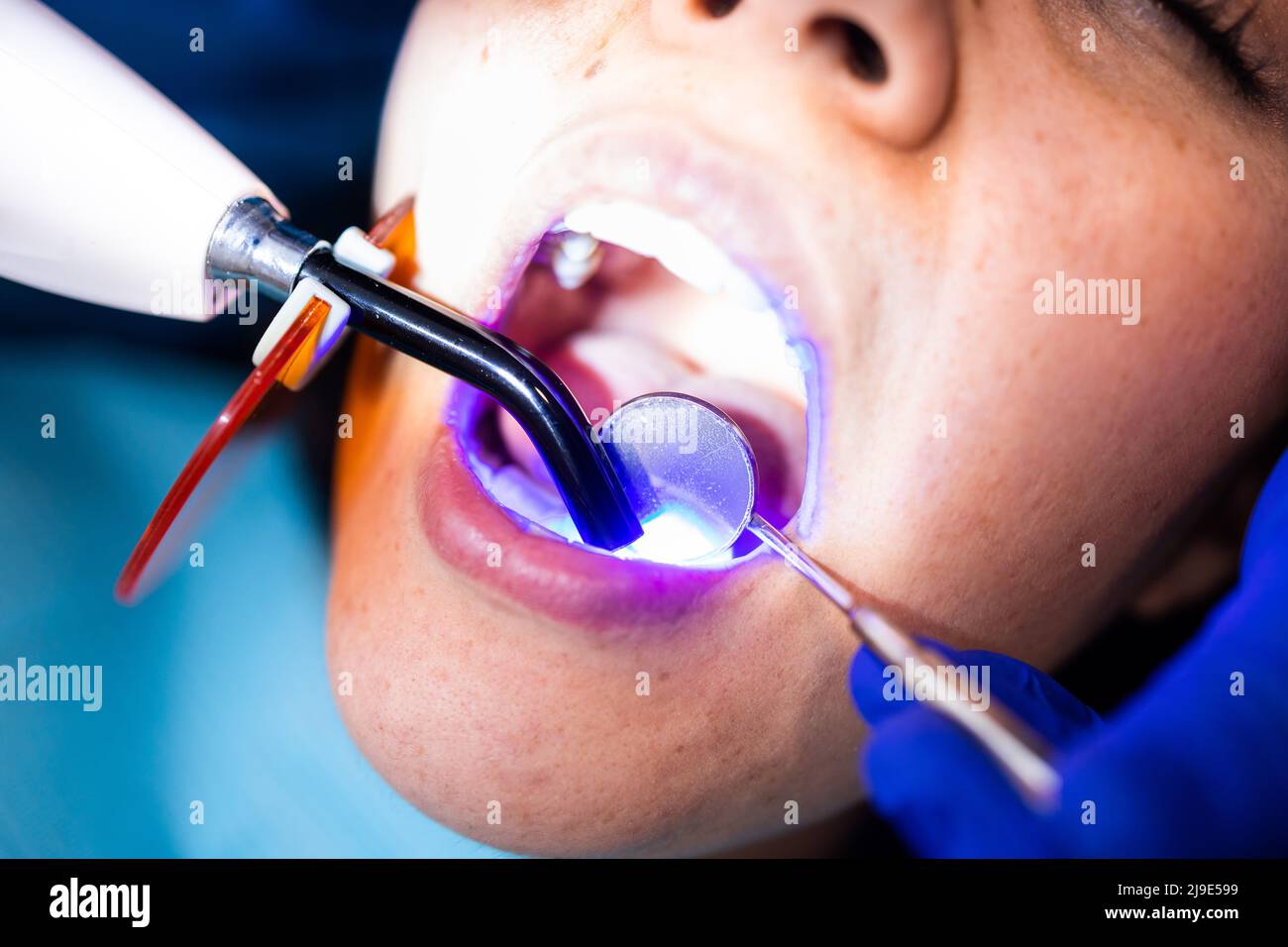 Tooth restoration with filling and polymerization lamp. Dental curing light setting composite resins. Stock Photo