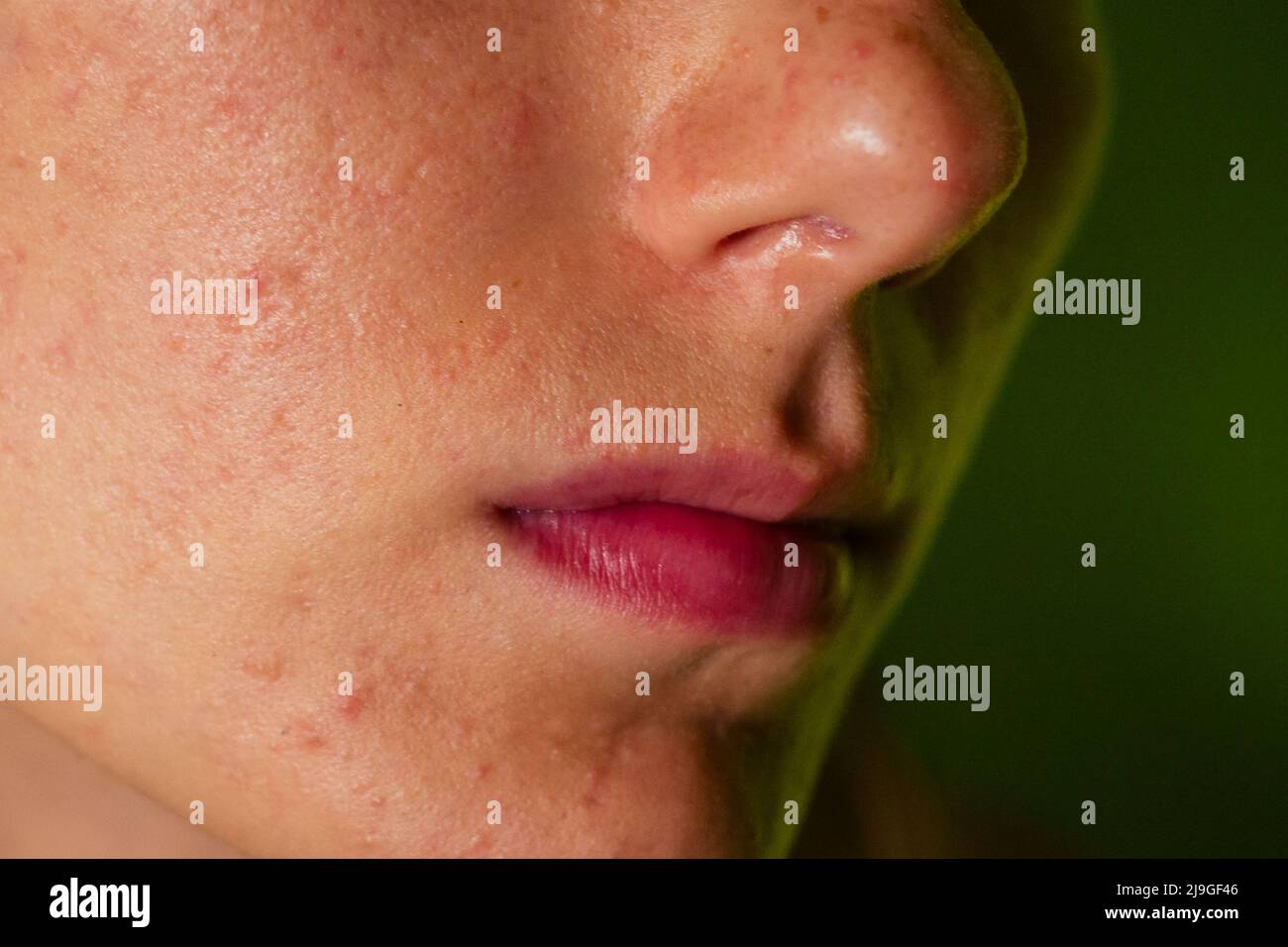 post-acne, scars and red festering pimples on the face of a young woman. concept of skin problems and harmonic failure Stock Photo