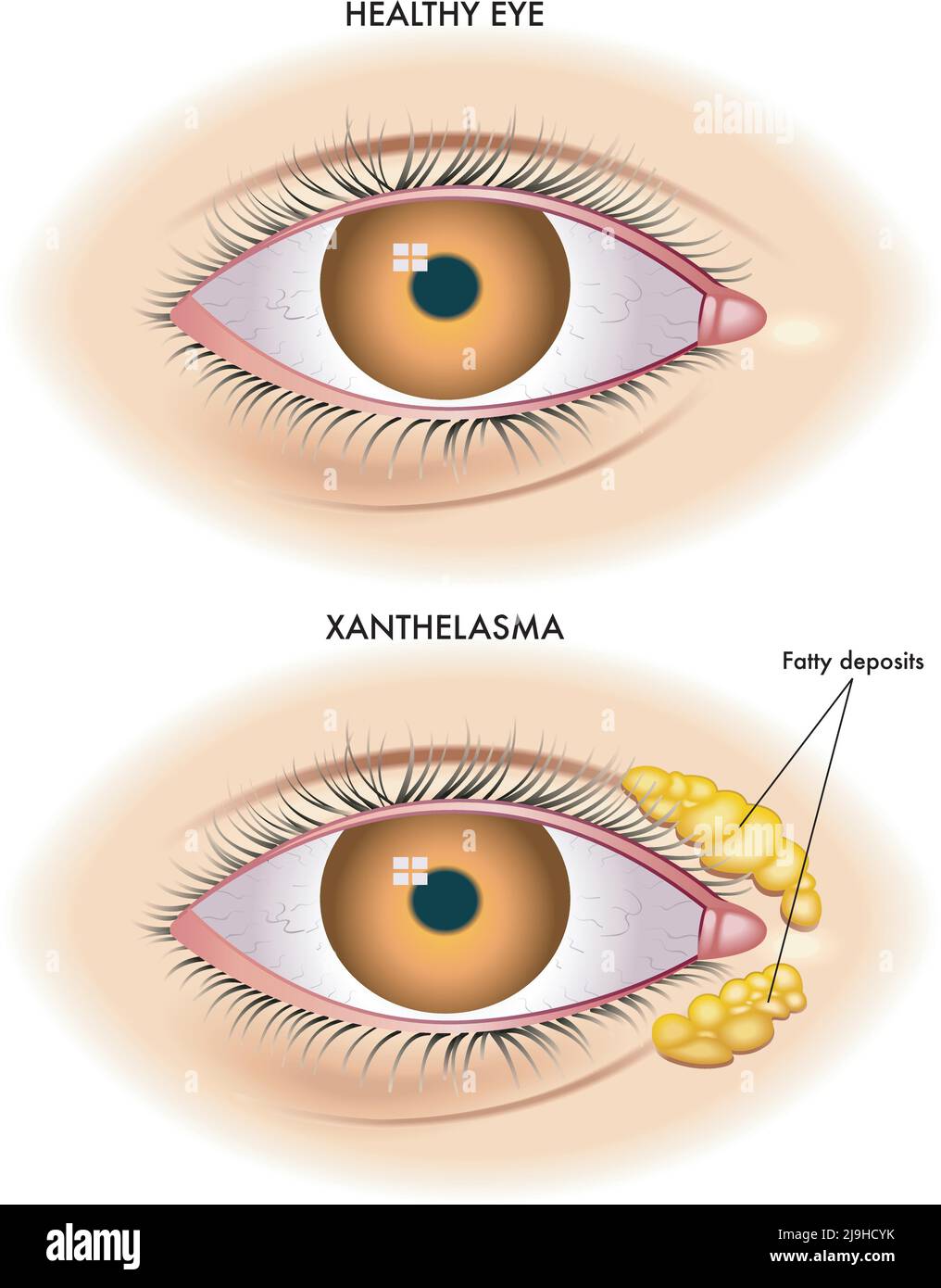 Medical illustration shows the comparison between a normal eye and one affected by xanthelasma. Stock Vector