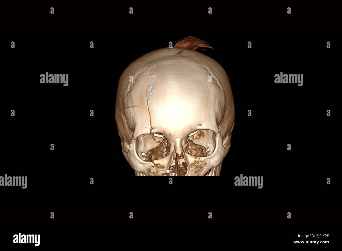 computed tomography of the skull with a cracked forehead after falling, skull fracture, 3D computed tomography of the skull Stock Photo