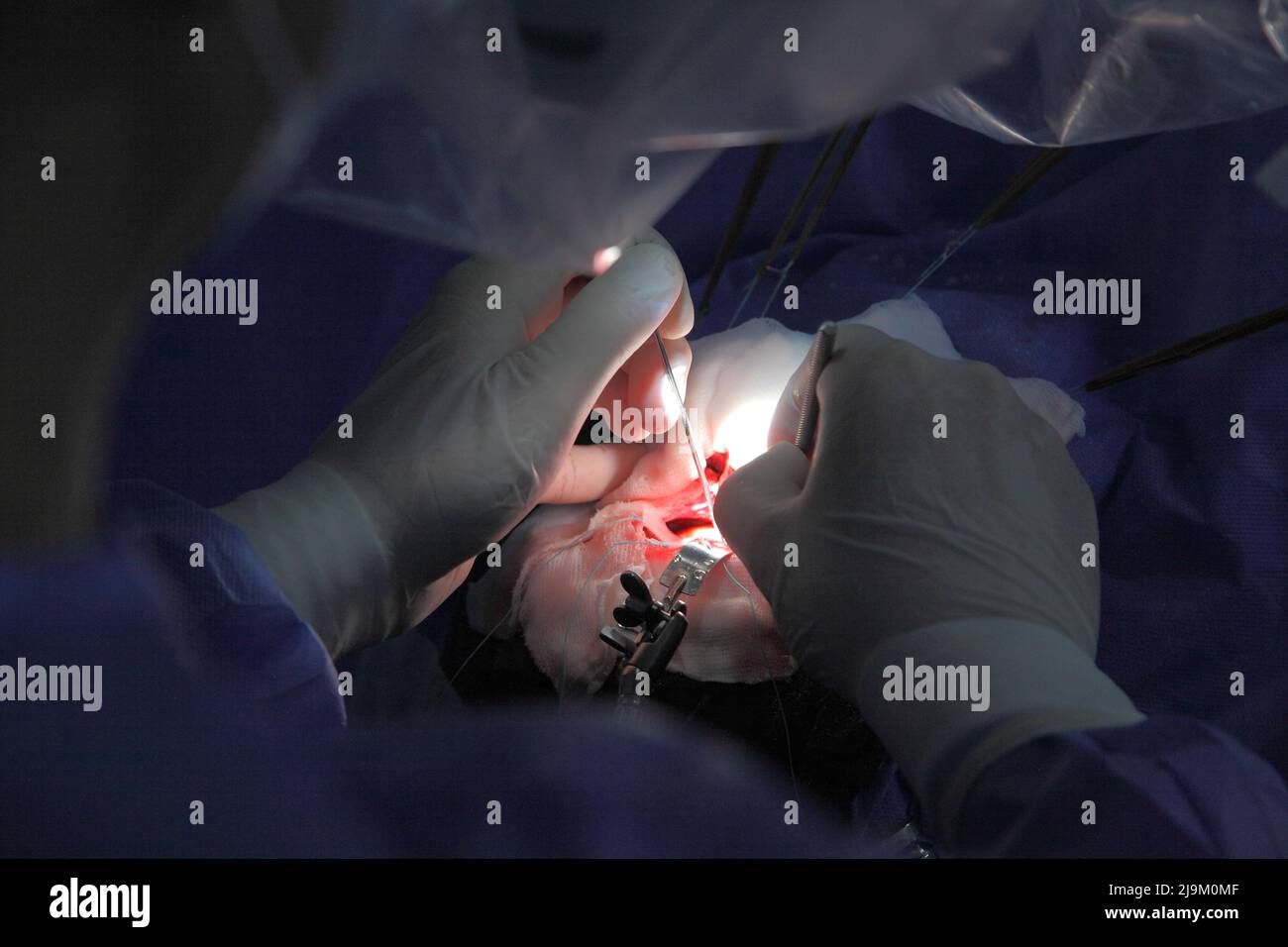 Treatment of a brain aneurysm. Surgical operation on the brain. A team of surgeons performing brain surgery to remove a tumor. Stock Photo