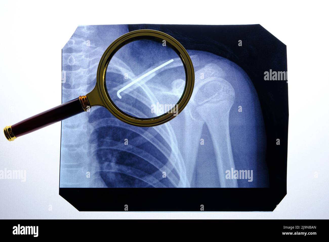 X-ray broken collarbone and spoke inserted into it Stock Photo