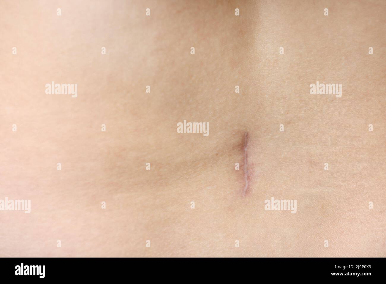 Appendicitis scar hi-res stock photography and images - Alamy