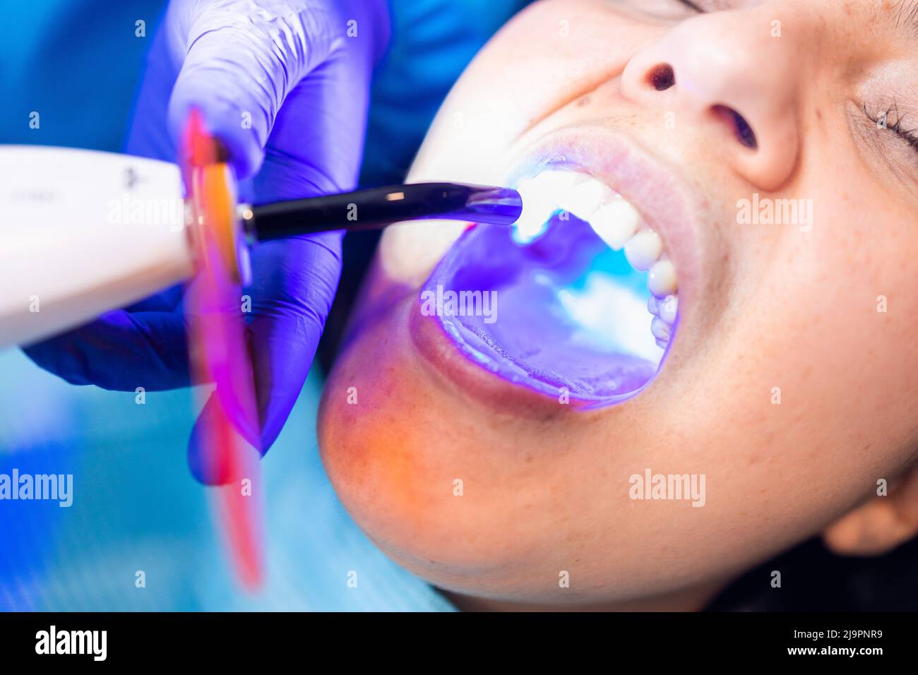 Tooth restoration with filling and polymerization lamp. Dental curing light setting composite resins. Stock Photo