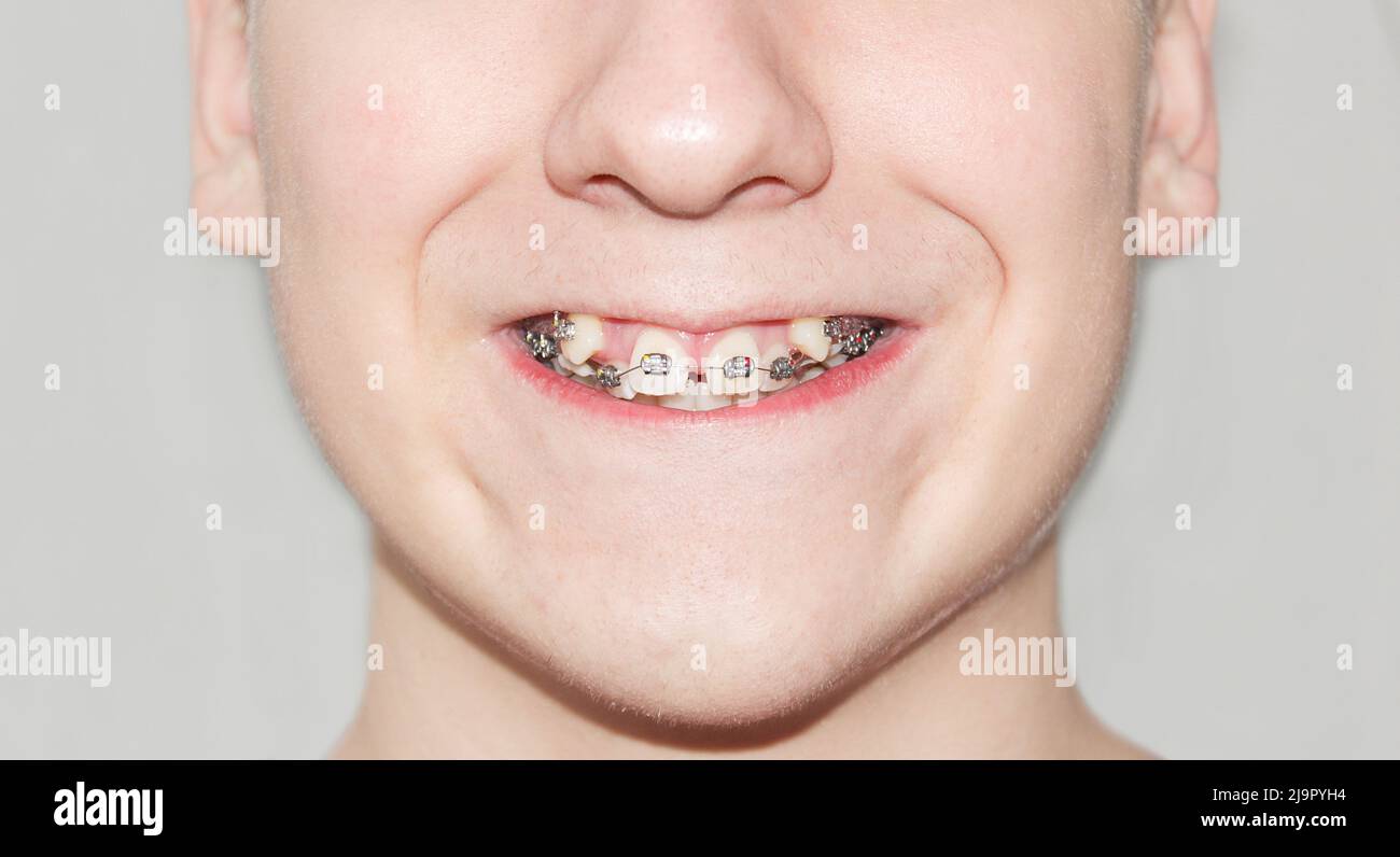 Correction of crooked teeth hi-res stock photography and images - Alamy