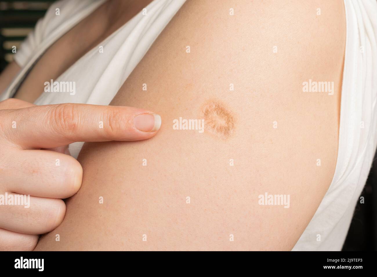 Monkeypox and smallpox vaccine scar on a woman's left arm Stock Photo