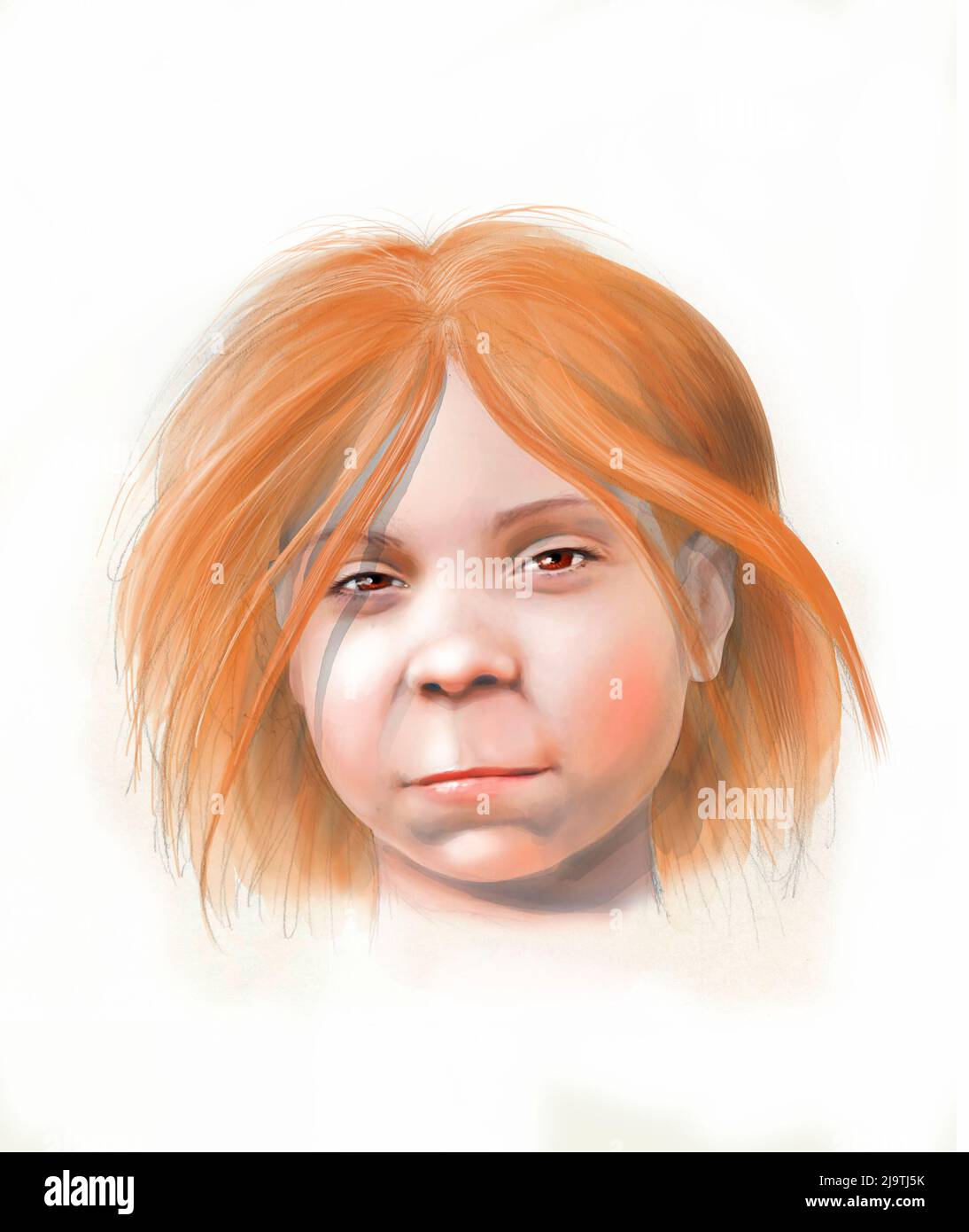 Teenage girl with foetal alcohol syndrome, illustration Stock Photo Alamy